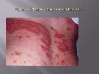 psoriosis.pptx