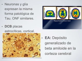 • Neuronas y glía
expresan la misma
forma patológica de
Tau. ONF similares.
• DCB placas
astrocíticas, cortical.
• EA: Depósito
generalizado de
beta amiloide en la
corteza cerebral
 