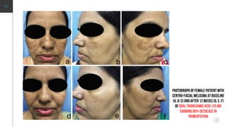 NEXT
Photograph of female patient with
centro-facial melasma at baseline
(a, b, c) and after 12 weeks (d, e, f)
of oral tranexamic acid 125 mg
showing 80% decrease in
pigmentation
 