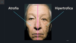 NEXT
Hipertrofica
Atrofia
 