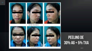 NEXT
Peeling de
30% AG + 5% TXa
 