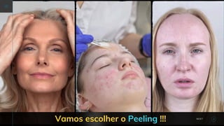 Vamos escolher o Peeling !!! NEXT
 