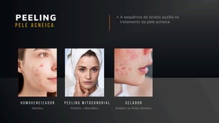 PEELING A sequência de ácidos auxilia no
tratamento da pele acneica
Salicílico Pirúvico + Mandélico
H O M O G E N E I Z A D O R P E E L I N G M I T O C O N D R I A L
P E L E A C N E I C A
Azelaico ou Ácido retinóico
S E L A D O R
 