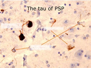 The tau of PSP Neurofibrillary tangles Tufted astrocytes (Oligodendroglial) Coiled bodies 