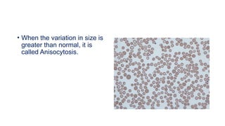 • When the variation in size is
greater than normal, it is
called Anisocytosis.
 