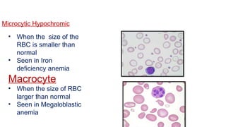 Microcytic Hypochromic
• When the size of the
RBC is smaller than
normal
• Seen in Iron
deficiency anemia
Macrocyte
• When the size of RBC
larger than normal
• Seen in Megaloblastic
anemia
 