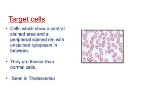 Target cells
• Cells which show a central
stained area and a
peripheral stained rim with
unstained cytoplasm in
between.
• They are thinner than
normal cells.
• Seen in Thalassemia
 