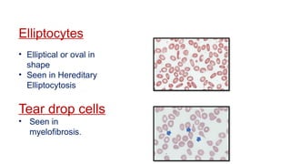 Elliptocytes
• Elliptical or oval in
shape
• Seen in Hereditary
Elliptocytosis
Tear drop cells
• Seen in
myelofibrosis.
 