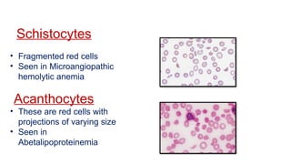 Schistocytes
• Fragmented red cells
• Seen in Microangiopathic
hemolytic anemia
Acanthocytes
• These are red cells with
projections of varying size
• Seen in
Abetalipoproteinemia
 
