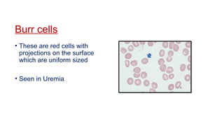 Burr cells
• These are red cells with
projections on the surface
which are uniform sized
• Seen in Uremia.
 