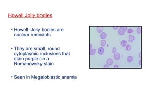 Howell Jolly bodies
• Howell–Jolly bodies are
nuclear remnants.
• They are small, round
cytoplasmic inclusions that
stain purple on a
Romanowsky stain
• Seen in Megaloblastic anemia
 