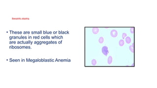 Basophilic stippling
• These are small blue or black
granules in red cells which
are actually aggregates of
ribosomes.
• Seen in Megaloblastic Anemia
 