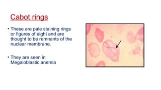 Cabot rings
• These are pale staining rings
or figures of eight and are
thought to be remnants of the
nuclear membrane.
• They are seen in
Megaloblastic anemia
 