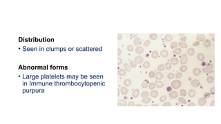 Distribution
• Seen in clumps or scattered
Abnormal forms
• Large platelets may be seen
in Immune thrombocytopenic
purpura
 