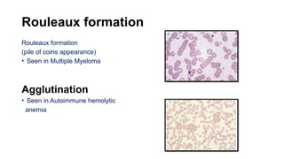 Rouleaux formation
Rouleaux formation
(pile of coins appearance)
• Seen in Multiple Myeloma
Agglutination
• Seen in Autoimmune hemolytic
anemia
 