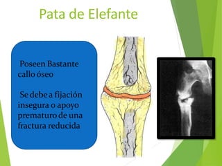 Pata de Elefante
Poseen Bastante
callo óseo
Sedebea fijación
insegura o apoyo
prematurode una
fractura reducida
 