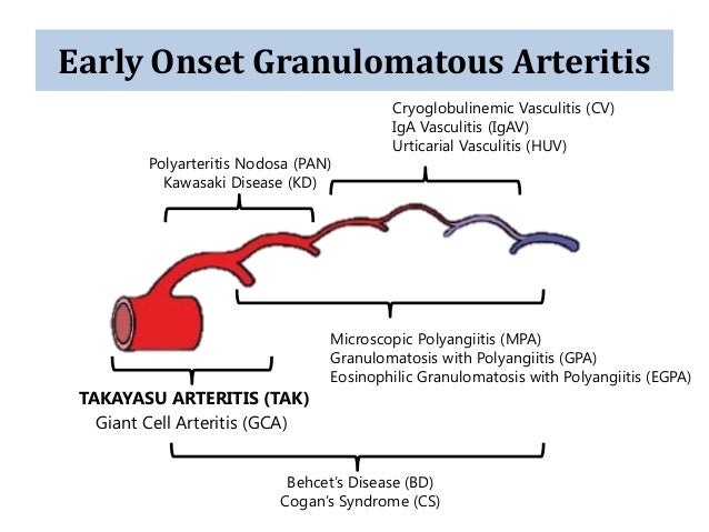 Kawasaki Arteritis Kawasaki Arteritis