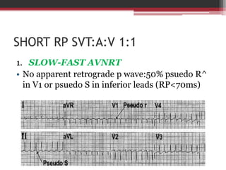 Psvt | PPTX