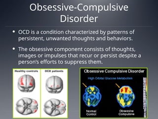 Obsessive-Compulsive
Disorder
 OCD is a condition characterized by patterns of
persistent, unwanted thoughts and behaviors.
 The obsessive component consists of thoughts,
images or impulses that recur or persist despite a
person’s efforts to suppress them.
 