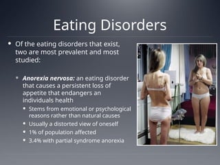 Eating Disorders
 Of the eating disorders that exist,
two are most prevalent and most
studied:
 Anorexia nervosa: an eating disorder
that causes a persistent loss of
appetite that endangers an
individuals health
 Stems from emotional or psychological
reasons rather than natural causes
 Usually a distorted view of oneself
 1% of population affected
 3.4% with partial syndrome anorexia
 