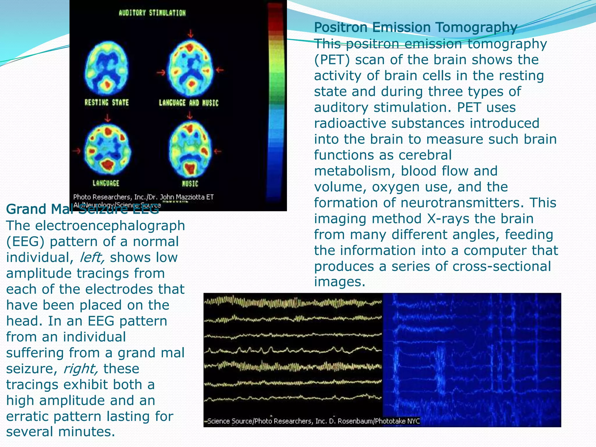                                                                                     Brain Activity in MemoryPositron emission tomography (PET) scans reveal brain regions involved in memory. Left, an encoding task (the initial processing of information into memory) activates the left prefrontal cortex. Right, an attempt to retrieve memories activates the right prefrontal cortex.