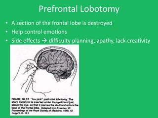 Prefrontal Lobotomy
• A section of the frontal lobe is destroyed
• Help control emotions
• Side effects  difficulty planning, apathy, lack creativity
 
