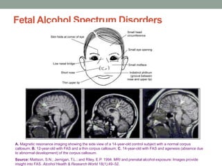 Fetal Alcohol Spectrum Disorders
A. Magnetic resonance imaging showing the side view of a 14-year-old control subject with a normal corpus
callosum; B. 12-year-old with FAS and a thin corpus callosum; C. 14-year-old with FAS and agenesis (absence due
to abnormal development) of the corpus callosum.
Source: Mattson, S.N.; Jernigan, T.L.; and Riley, E.P. 1994. MRI and prenatal alcohol exposure: Images provide
insight into FAS. Alcohol Health & Research World 18(1):49–52.
 