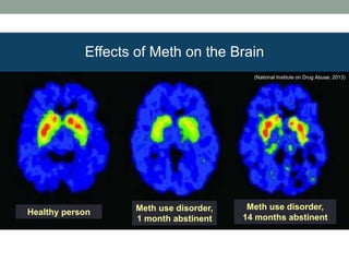Healthy person Meth use disorder,
1 month abstinent
Meth use disorder,
14 months abstinent
Effects of Meth on the Brain
(National Institute on Drug Abuse, 2013)
 