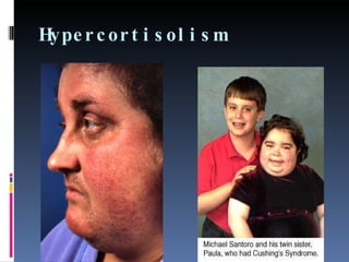 Hypercortisolism  