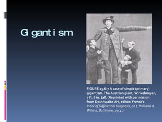 Gigantism FIGURE 25.6-7 A case of simple (primary) gigantism. The Austrian giant, Winkelmeyer, 7 ft. 6 in. tall. (Reprinted with permission from Douthwaite AH, editor:  French's Index of Differential Diagnosis, ed 7. Williams & Wilkins, Baltimore, 1954.)‏ 