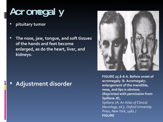 Acromegaly pituitary tumor The nose, jaw, tongue, and soft tissues of the hands and feet become enlarged, as do the heart, liver, and kidneys.  Adjustment disorder FIGURE 25.6-6 A. Before onset of acromegaly. B. Acromegaly: enlargement of the mandible, nose, and lips is obvious. (Reprinted with permission from Spillane JD, Spillane JA:  An Atlas of Clinical Neurology, ed 3. Oxford University Press, New York, 1982.)‏ FIGURE 