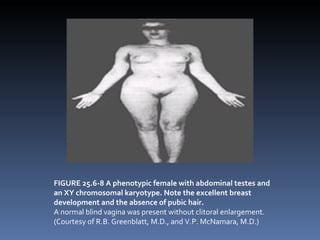 FIGURE 25.6-8 A phenotypic female with abdominal testes and an XY chromosomal karyotype. Note the excellent breast development and the absence of pubic hair. A normal blind vagina was present without clitoral enlargement. (Courtesy of R.B. Greenblatt, M.D., and V.P. McNamara, M.D.)‏ 