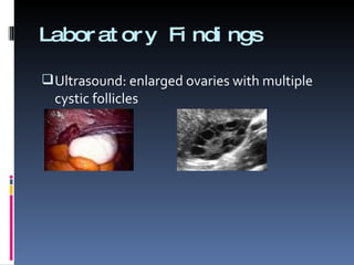Laboratory Findings Ultrasound: enlarged ovaries with multiple cystic follicles 