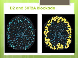 D2 and 5HT2A Blockade
 