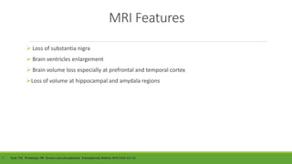 MRI Features
 Loss of substantia nigra
 Brain ventricles enlargement
 Brain volume loss especially at prefrontal and temporal cortex
Loss of volume at hippocampal and amydala regions
1. Hyde TM, Weinberger DR. Seizures and schizopherenia. Schizopherenia Bulletin.2010;23(4): 611-22
 
