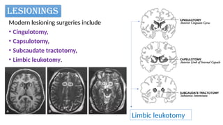 Lesionig Comprehensive Overview of Psychosurgery: History, Techniques, and ...