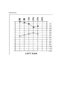 Pure Tone Audiometry | PDF