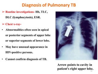 Diagnosis of Pulmonary TB
➢ Routine investigations- Hb, TLC,
DLC (lymphocytosis), ESR.
➢ Chest x-ray-
• Abnormalities often seen in apical
or posterior segments of upper lobe
or superior segments of lower lobe.
• May have unusual appearance in
HIV-positive persons.
• Cannot confirm diagnosis of TB.
Arrow points to cavity in
patient's right upper lobe.
15
 
