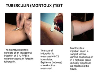 TUBERCULIN (MONTOUX )TEST
The Mantoux skin test
consists of an intradermal
injection of 5 IU PPD is
extensor aspect of forearm
tuberculin.
The size of
induration is
measured 48–72
hours later.
Erythema (redness)
should not be
measured.
Mantoux test
injection site in a
subject without
chronic conditions or
in a high risk group
clinically diagnosed
as negative at 50
hours.
 