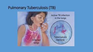 Pulmonary Tuberculosis (TB)
 