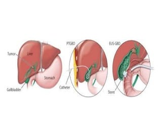 Transhepatic Approach percutaneous transhepatic cholecystography | PPTX