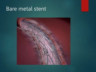 Bare metal stent
 