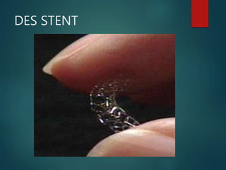 DES STENT
 