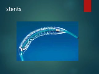 stents
 