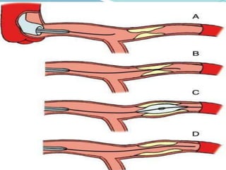 Ptca vs cabg | PPTX