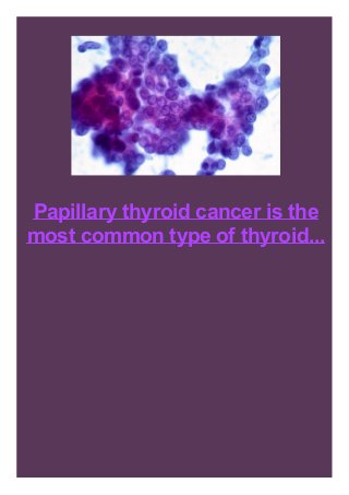 Papillary thyroid cancer is the
most common type of thyroid...
 
