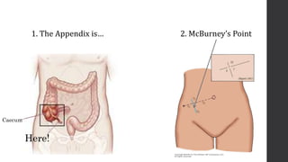 Appendix Pain Point appendicitis | PPTX