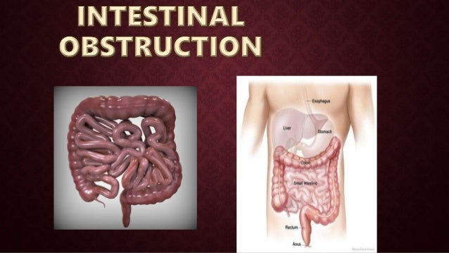Intestinal Obstruction intestinal-obstruction