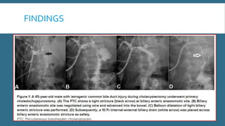 Ptc )percutaneous transhepatic cholangiography | PPTX