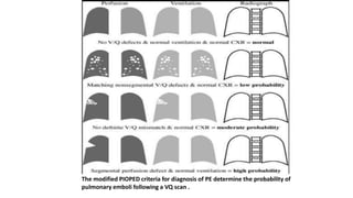 The modified PIOPED criteria for diagnosis of PE determine the probability of
pulmonary emboli following a VQ scan .
 